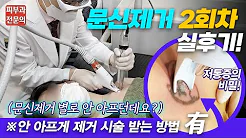 실제 문신제거 후기 | 2회차 시술로 얼마나 빠지냐면요~!👀 피코웨이 레이저 문신제거 과정 공개!