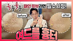 여드름 흉터+붉은 자국 없애는 가장 확실한 방법! 한방에 싹 정리! | 피부과전문의